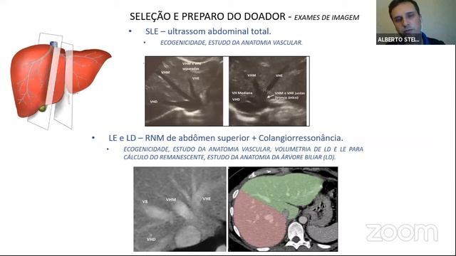 Reunião Científica - Transplante Hepático Pediátrico - Dr. Alberto Buge - LITOESLIGA смотреть онлайн