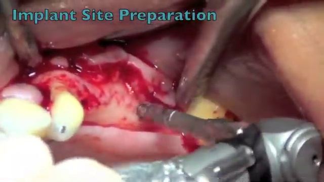 Lateral Window Sinus Elevation | NovaBone Dental Products смотреть онлайн