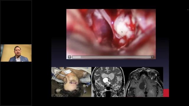 James Liu, MD — Accessing Deep Seated Skull Base Lesions смотреть онлайн