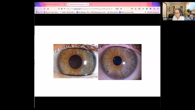 Iridology - What changes we see in irides... смотреть онлайн