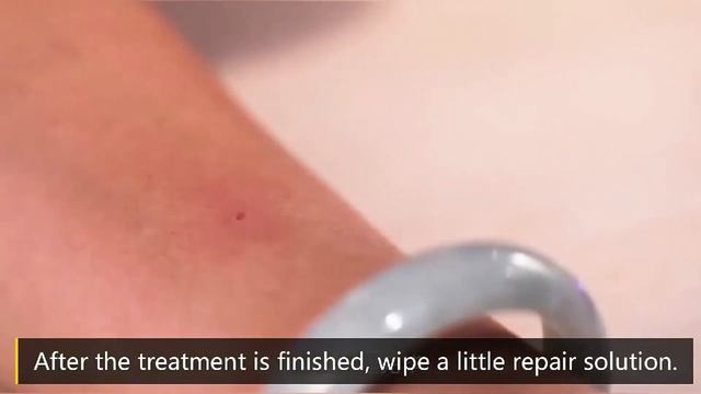 Plasma Pen Skin Tag & Mole Remover | Fibroblast Skin Tightening смотреть онлайн