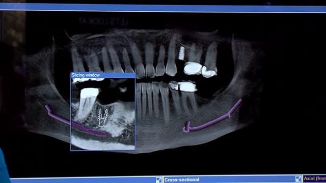 3D CT Scans for Dental Implant Patients смотреть онлайн