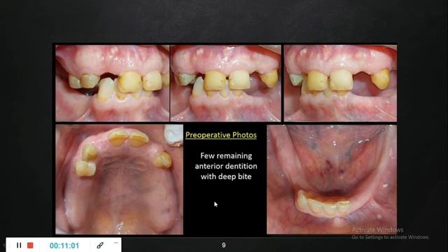 Ep.7 Prosthetic Driven #Dental #Implant Placement By Dr.Shimaa AlSharkawy смотреть онлайн