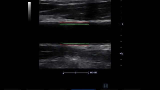 Measurements from Arterial Ultrasound Imaging (MAUI) Tracking Example смотреть онлайн