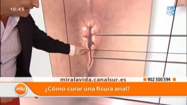 Fisura Anal Médicos Mira la Vida смотреть онлайн