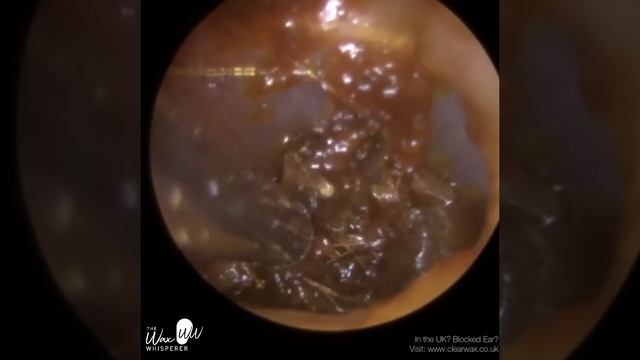 980 - Tough Ear Wax Removal смотреть онлайн