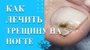 Онихорексис, что это? Трещина на ногте, как убрать.