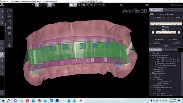 Проектирование шаблона для брекетов