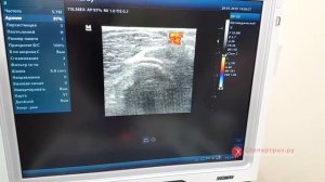 УЗИ локтевого сустава