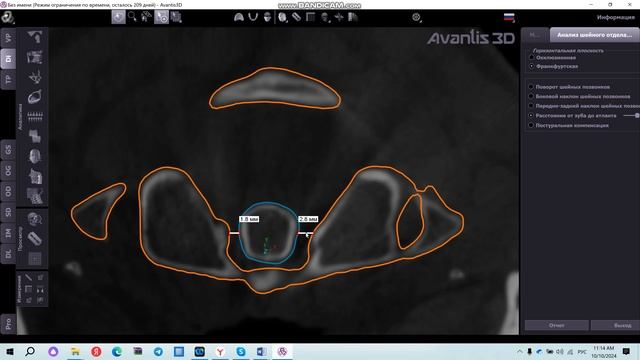 Анализ шейного отдела позвоночника