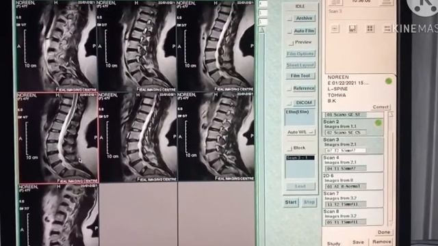 MRI scan for lumbar spine|on 0.3 tesla machine. смотреть онлайн