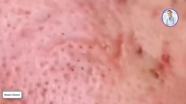 How To Removal Blackhead And How To Get Rid Of Blackhead Blackhead On Face #60