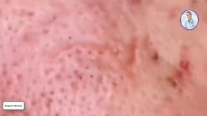 how to removal blackhead and how to get rid of blackhead blackhead on face #60