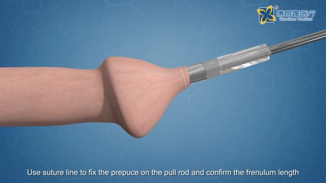 Condiner Disposable Circumcision Stapler смотреть онлайн