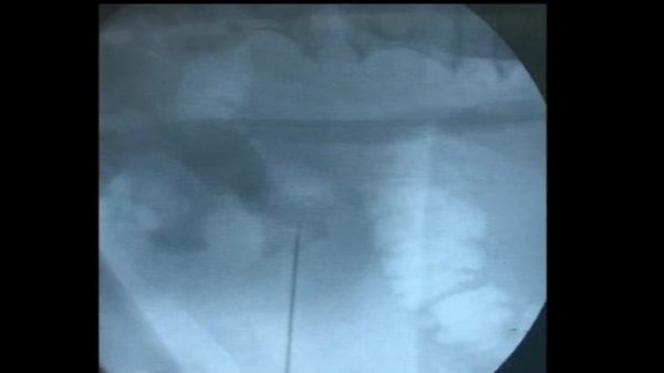 PCNL Access with Fluoroscopy   Eye of the needle Technique