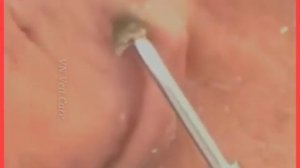 Новое выдавливание ПРЫЩЕЙ и ЧЕРНЫХ ТОЧЕК! Blackheads- Acne(Part 107)