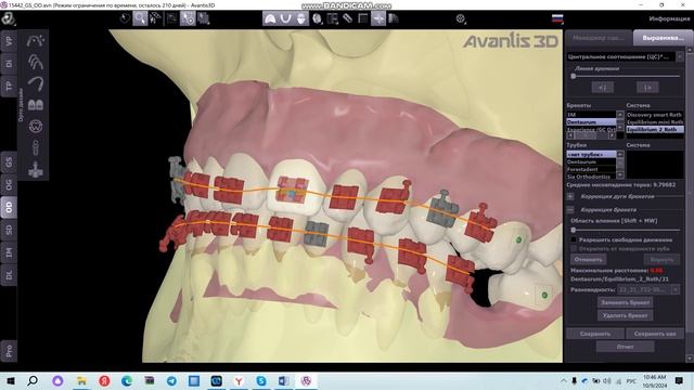 Расстановка брекетов
