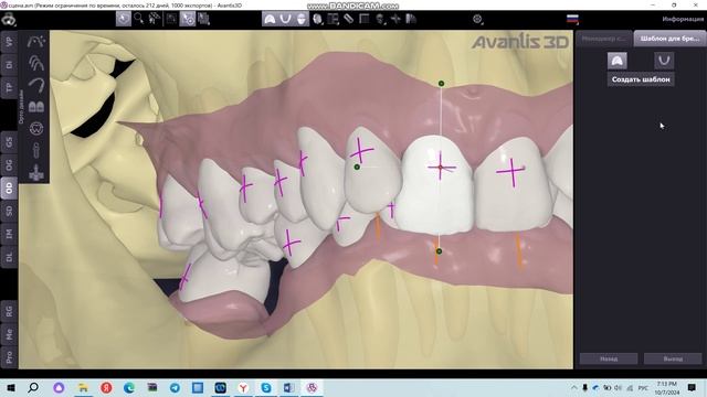 Шаблон для брекетов
