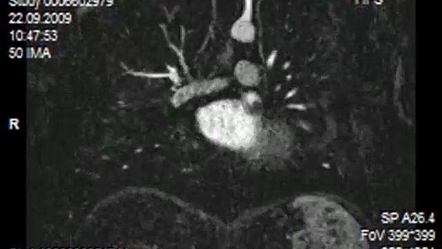 KM & ToF Angiographie смотреть онлайн