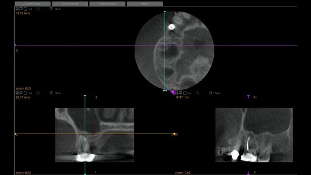 Crazy dental implant placement смотреть онлайн