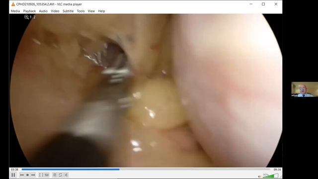 Deferred Live Hybrid OAGB , Prof Safwan Taha смотреть онлайн