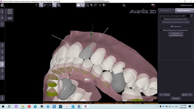 Постановка искусственных зубов