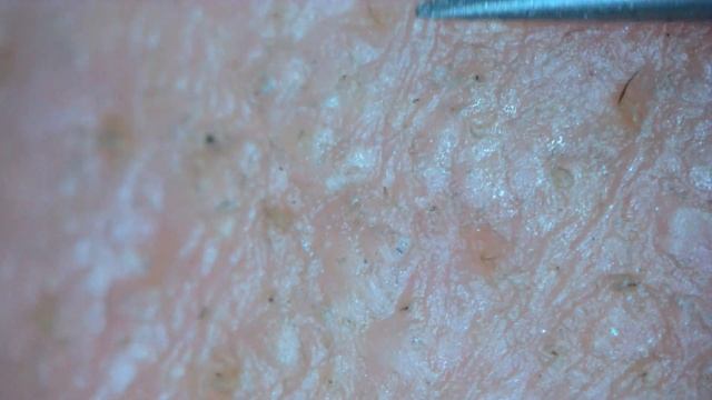 0236 keratin plug removal nose смотреть онлайн