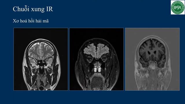 MRI - Chuỗi xung Inversion Recovery смотреть онлайн
