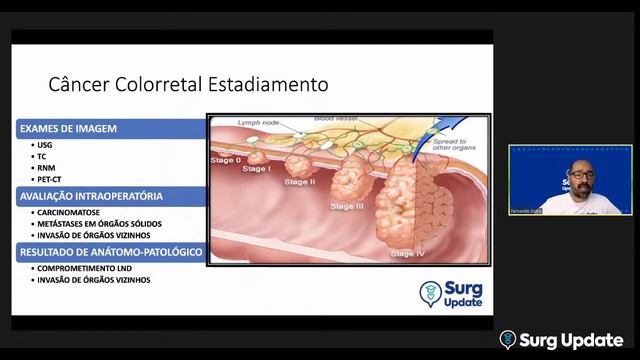 #018 - CÂNCER COLORRETAL E DE CANAL ANAL | Surg Update смотреть онлайн