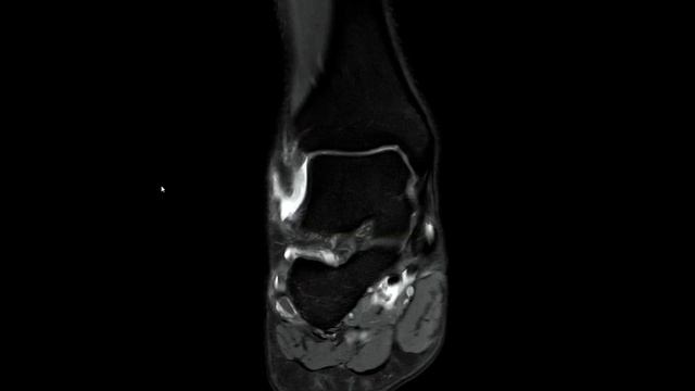 Tram track lesion on ankle MRI - MSK Quick Tip #5 смотреть онлайн
