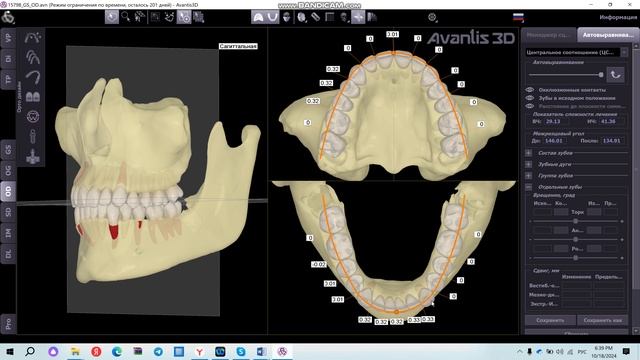 Автовыравнивание зубов