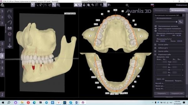 Автовыравнивание зубов