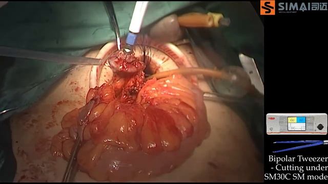 Laparoscopic surgery with SIMAI Bipolar Plasma System смотреть онлайн