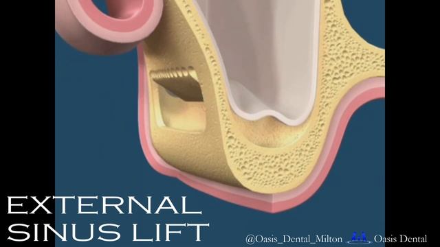 What is a Lateral Window Sinus Lift | Dental Implant Specialist Team Milton, Oakville, Mississauga смотреть онлайн