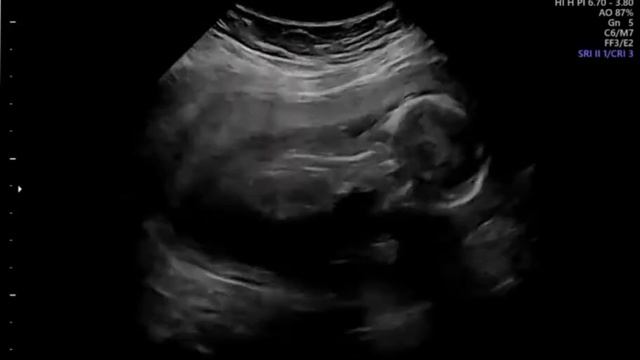 16+4 Gender Scan With Window To The Womb