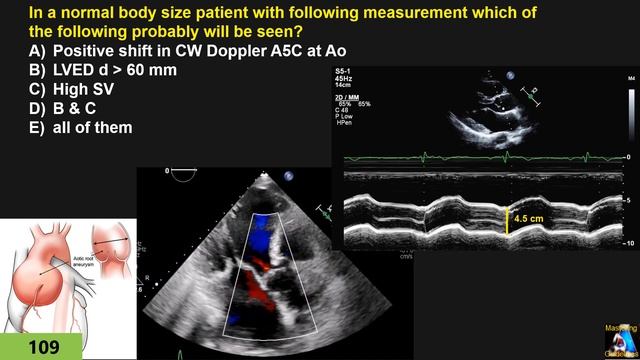 MCQ 10: TAPSE, Valvular, hemodynamic, Doppler, M-Mode смотреть онлайн