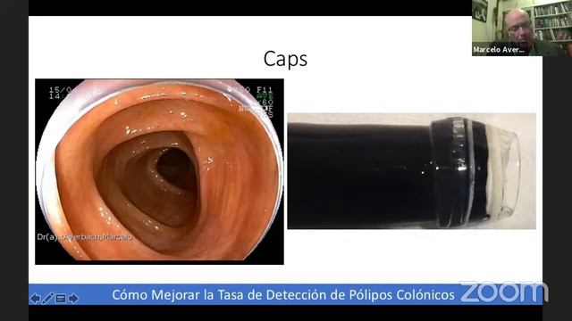 Webinar: Cómo mejorar la tasa de detección de Pólipos Colónicos / Cap: Endoscopía смотреть онлайн