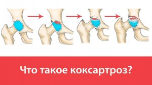 Что такое коксартроз тазобедренного сустава?