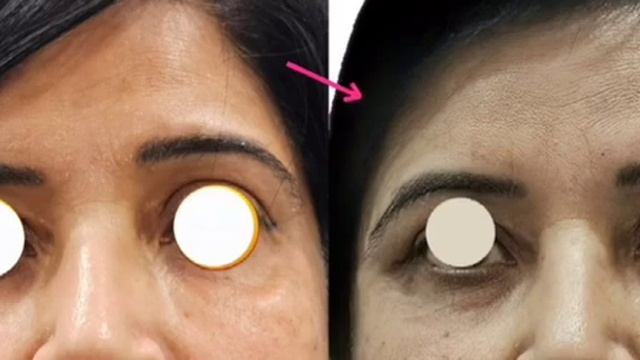 MAC offers option for both Surgical Endoscopic Browlift /Nonsurgical with Botox Fillers, Threads. смотреть онлайн