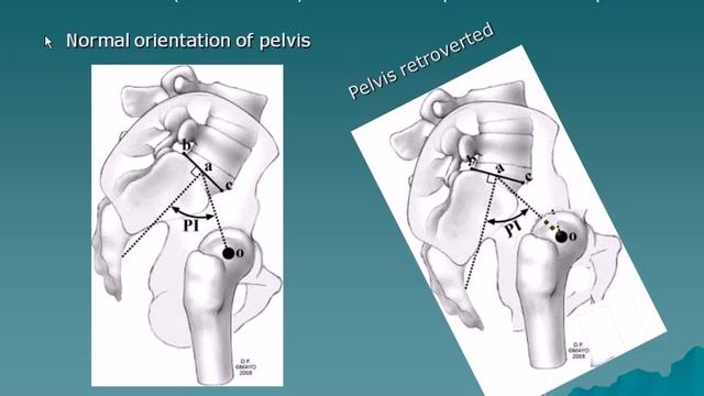 Evaluation and management of sagittal plane in adult deformity смотреть онлайн