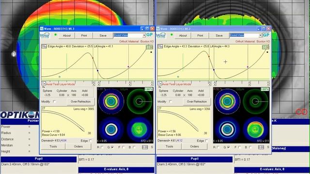 Legacy WAVE - Semi Scleral Semi Treatment смотреть онлайн