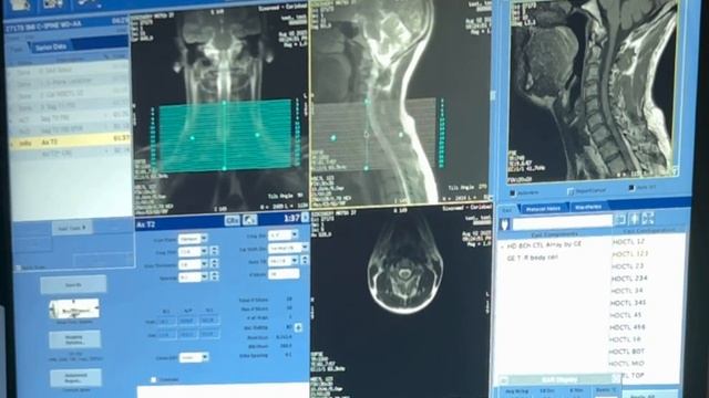 MRI- CERVICAL SPINE PLANNING смотреть онлайн