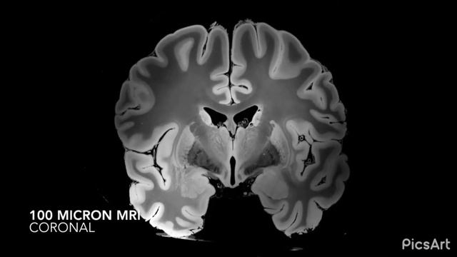 Tesla MRI _ Frequency 963