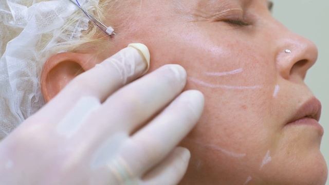 Тредлифтинг нитями COG