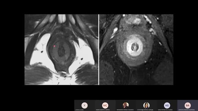 Anatomía y patología del canal anal por la Dra. Karla Reyna смотреть онлайн