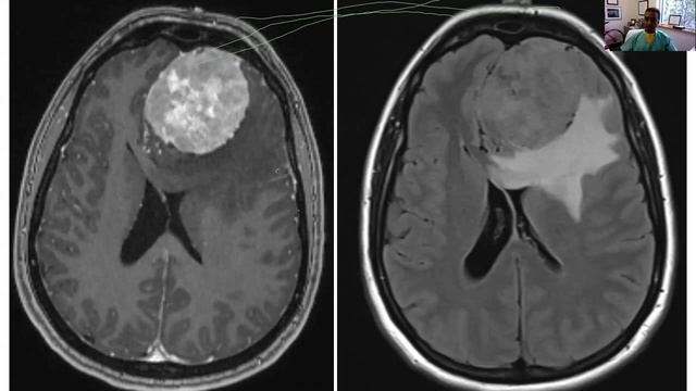 Headache and Eye Pain for the General Ophthalmologist. Prem Subramanian, MD. USA смотреть онлайн