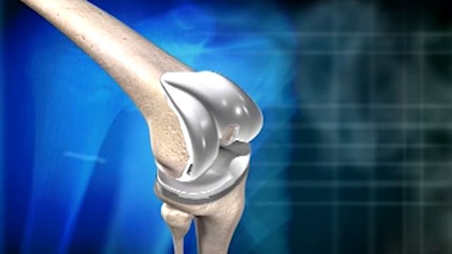 Learn About The Mako Robotic Arm With Dr. Niemann