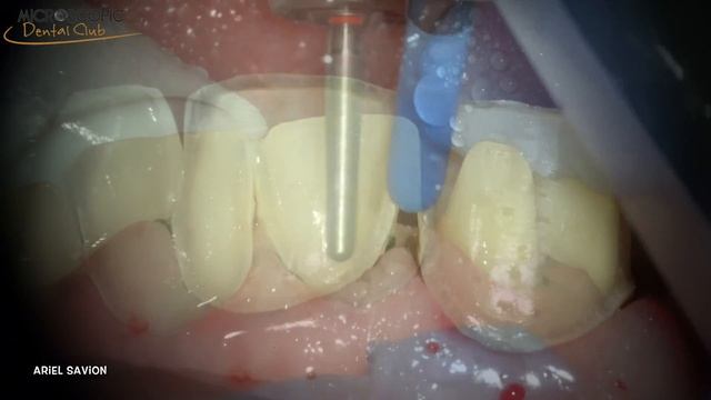 Achieving Perfect Dental Veneers with Microscopic Preparations by Dr. Ariel Savion смотреть онлайн