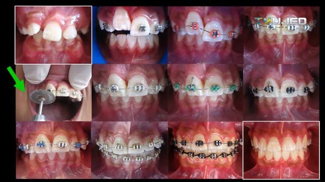 STRIPPING (INDICACIÓN DE DESGASTE INTERPROXIMAL EN ORTODONCIA) смотреть онлайн