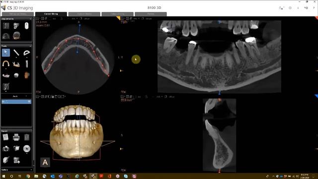 CS 3D Imaging: Utilizing The 3D Tools To Analyze 3D Volumes